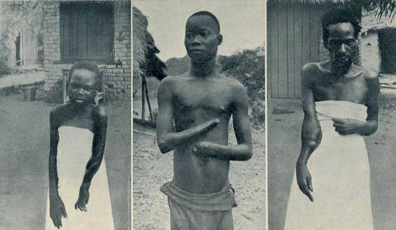 Les mains coupées du Congo belge